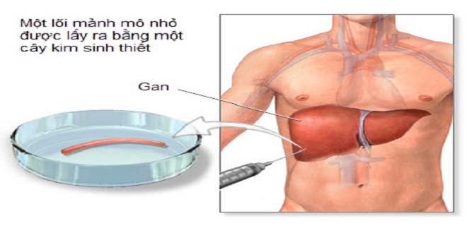 Sinh thiết gan